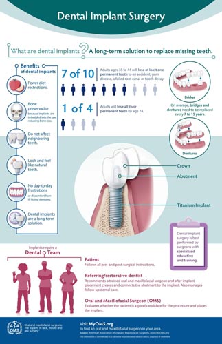 Dental Implants 